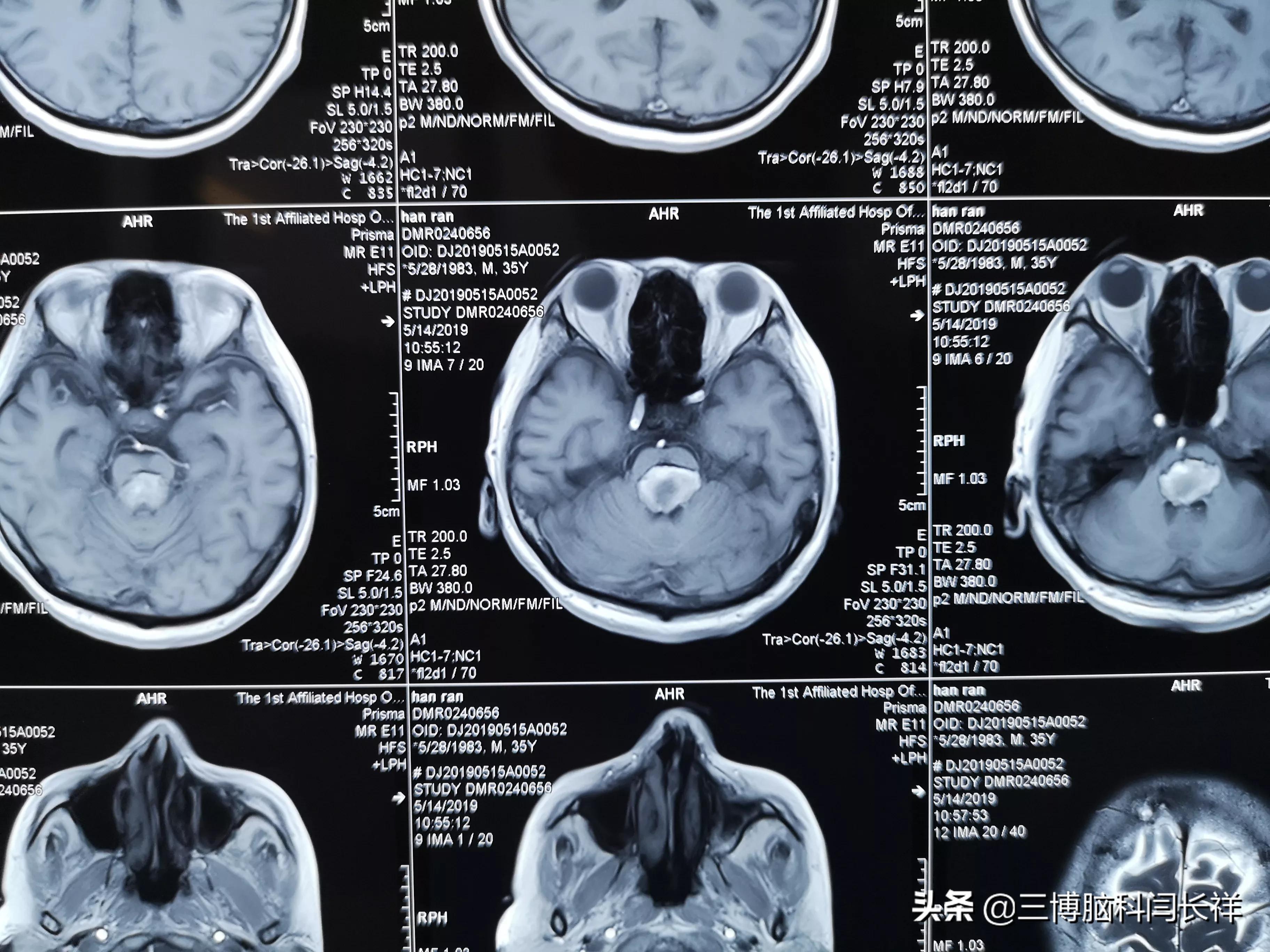 为何两种类型的脑干出血结局确大不同