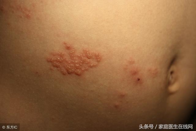 患蛇缠腰带状疱疹太疼了患病后要对3类食物忌口