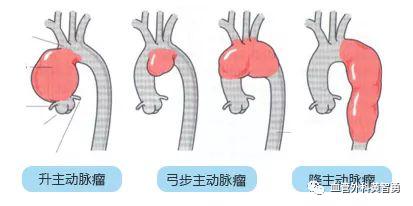 动脉瘤根据类型的不同,又可以分为真性动脉瘤,假性动脉瘤和夹层动脉瘤