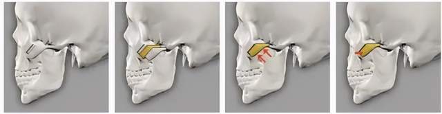 颧骨太高不美观 手术改善是越低越好吗 面部轮廓整形 面部轮廓整形