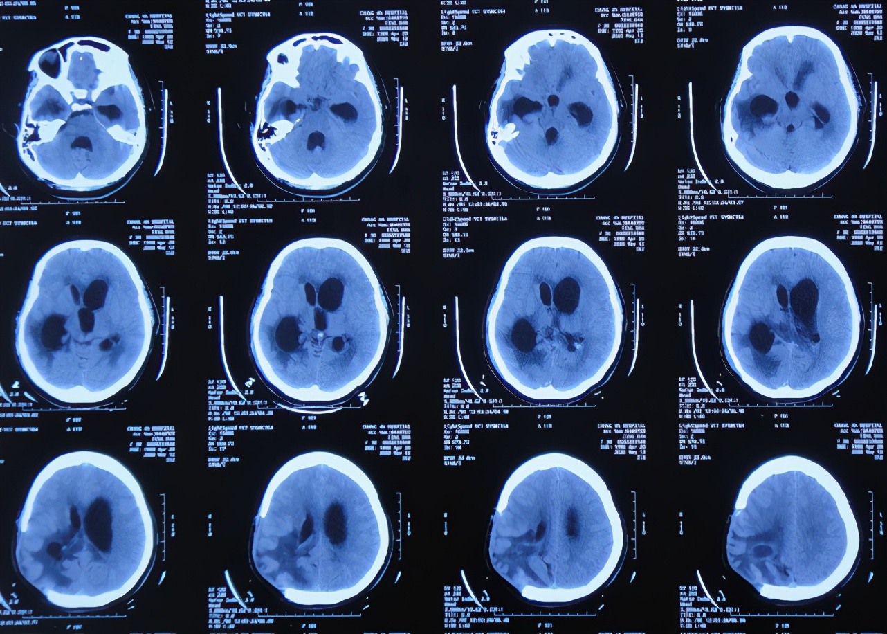 引流管第4次脫出後19天),複查頭顱ct示腦室持續擴大,輕度腦膨出(圖-6)