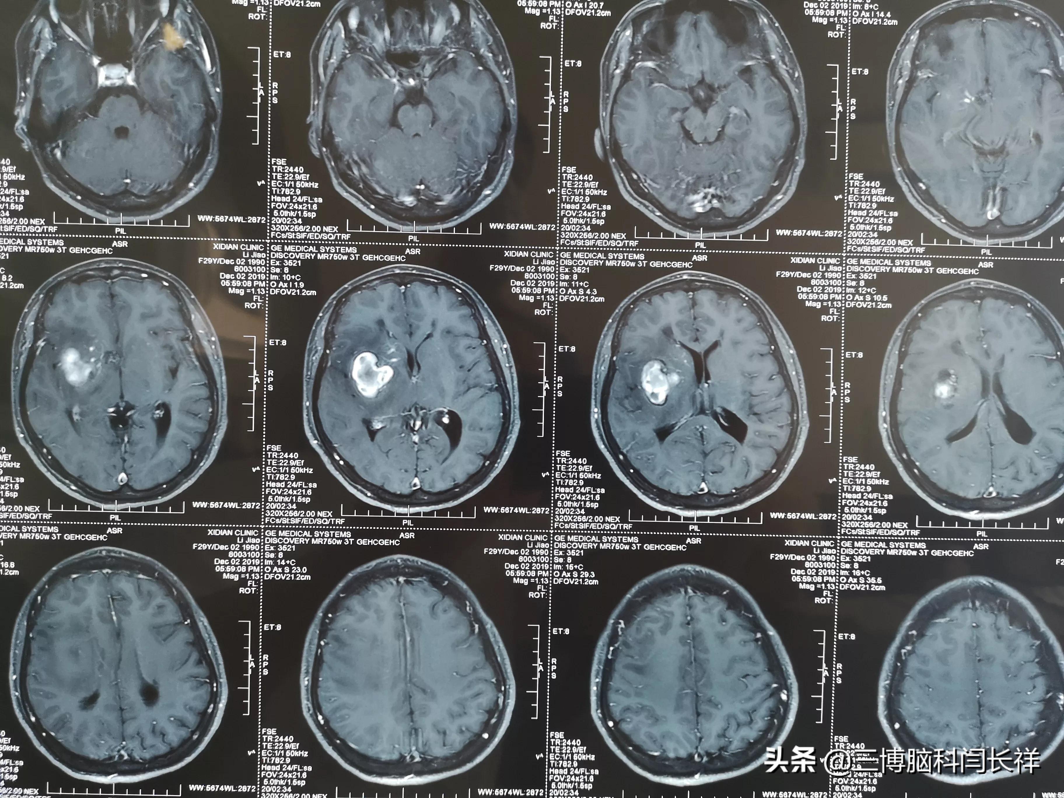 有出血史的脑内海绵状血管瘤要手术_海绵状血管瘤 - 好大夫在线
