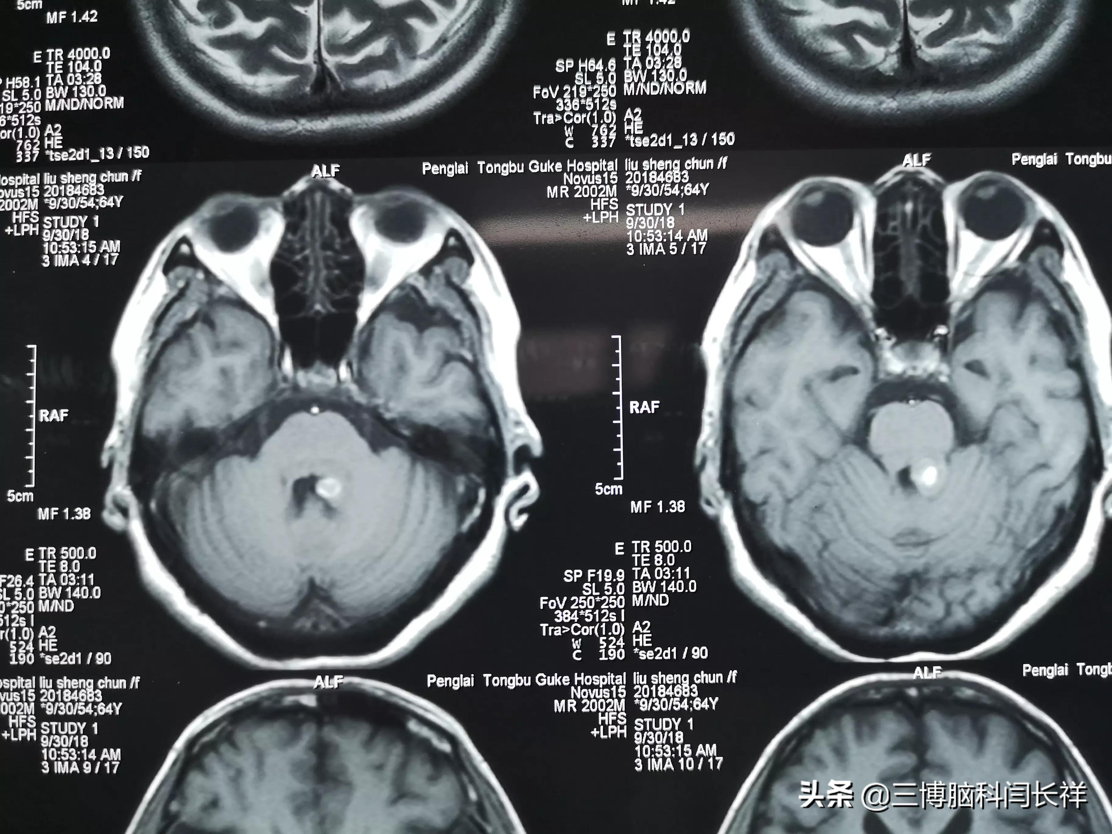 关于脑干海绵状血管瘤