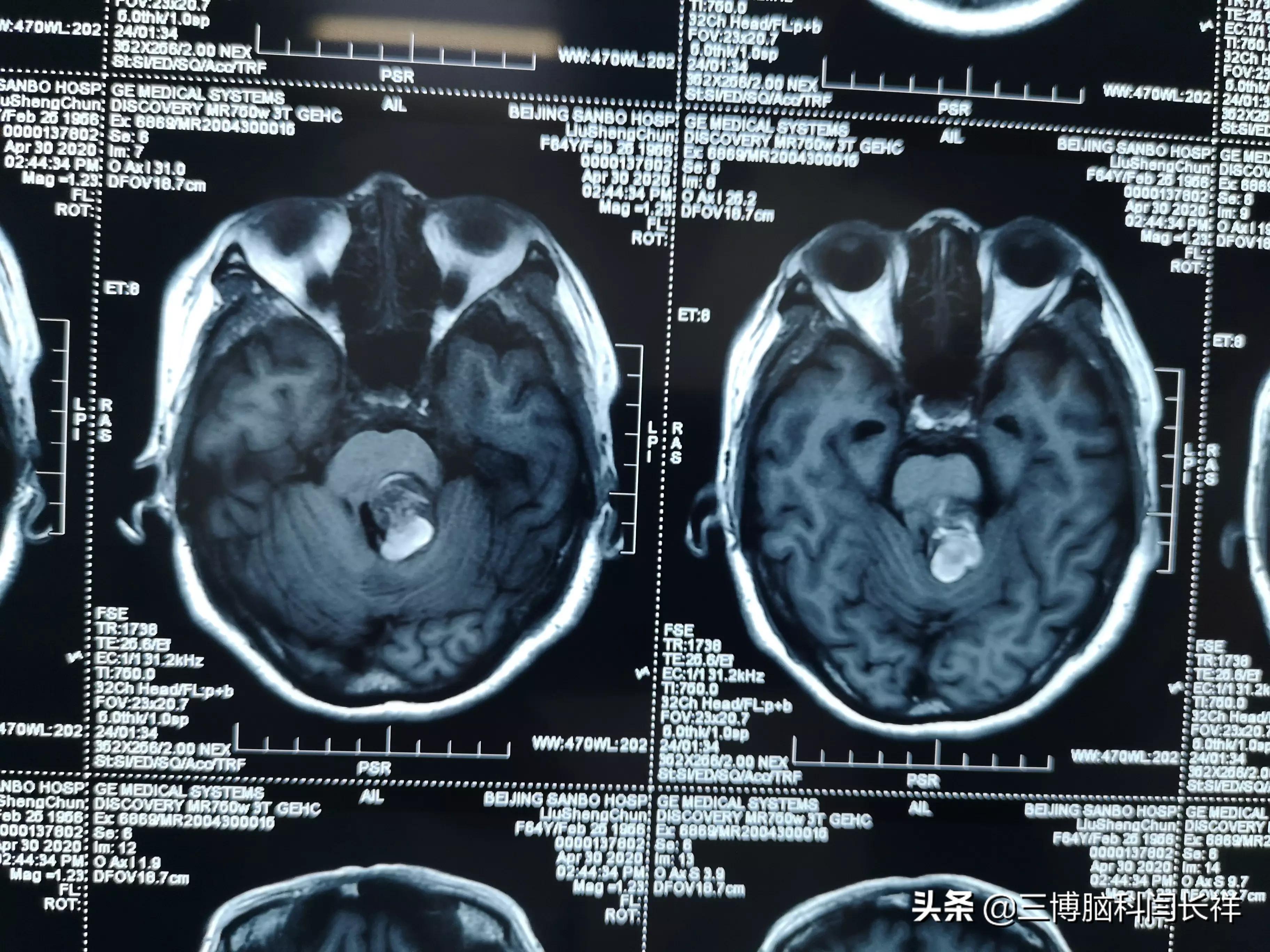关于脑干海绵状血管瘤