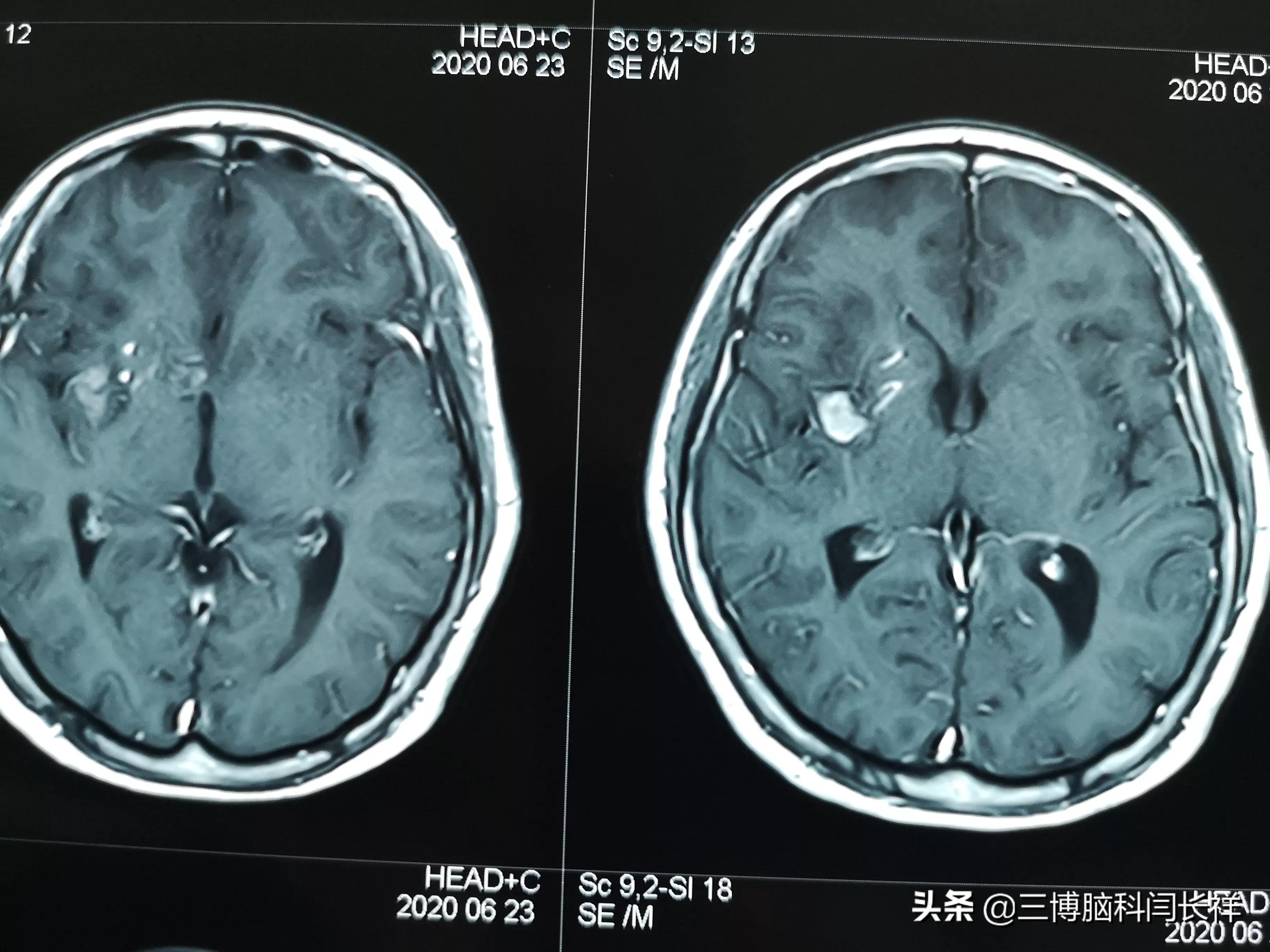 有出血史的脑内海绵状血管瘤要手术