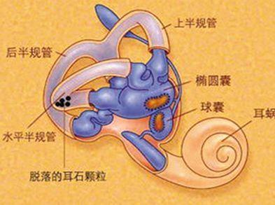 一分钟告诉你什么是耳石症