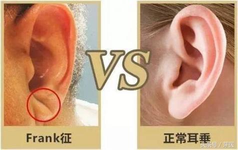 耳垂上的一道"沟",预示着冠心病可能降临