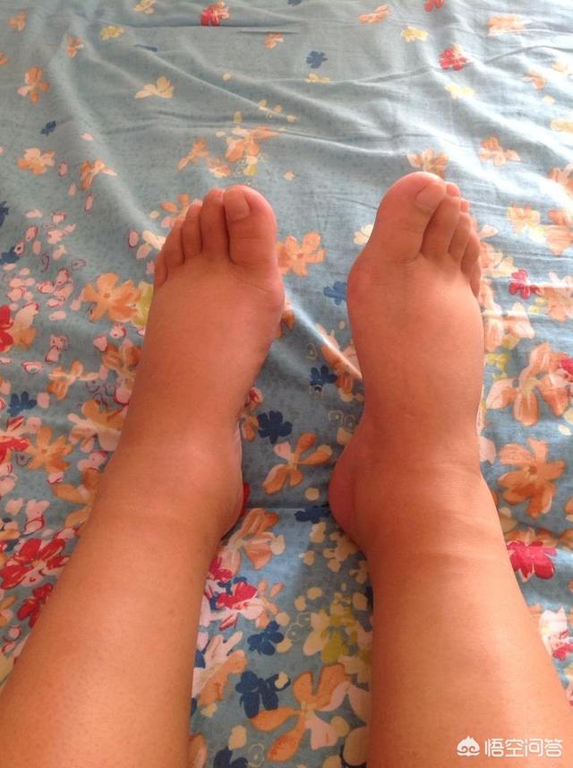 骨折手术后肢体肿胀疼痛是静脉血栓还是正常呢医生告诉您