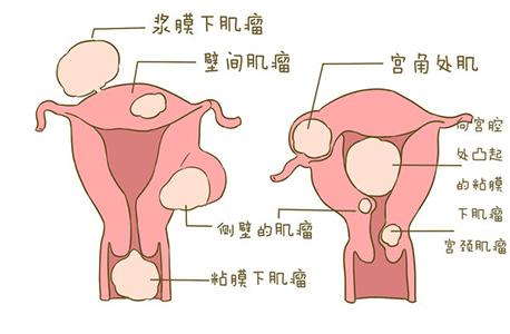 有问必答——宫腔粘连和难孕的那些事儿!_健康症状网