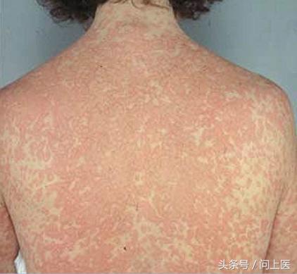 青霉素过敏的症状有哪些?你还不知道吗?严重可导致休克!_健康症状网