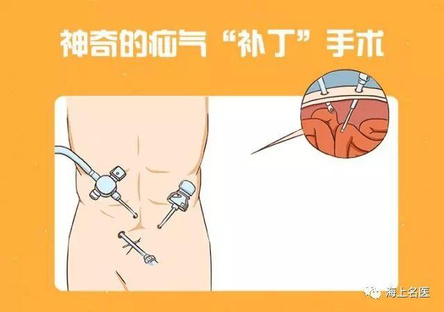 九院顾岩小洞不补大洞吃苦面对小肠气不可掉以轻心
