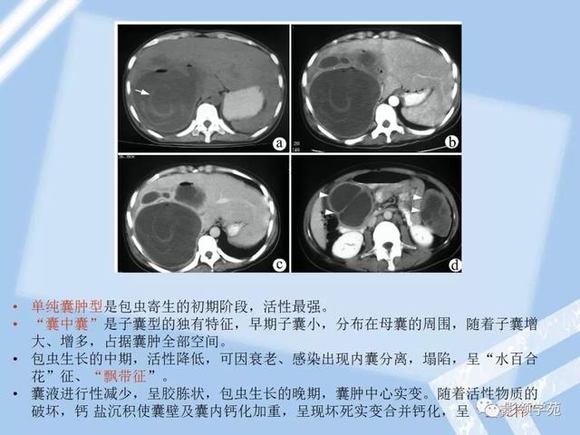 5,肝包蟲病4,腎細胞癌肝轉移腫瘤膨脹性生長,可有包膜,易出血,壞死,囊