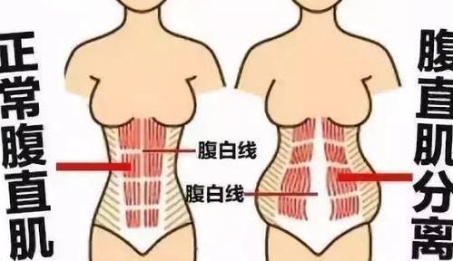 腹直肌分离宝妈一定不能忽视-在线订票-互动吧