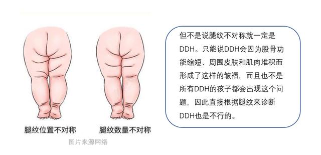 寶寶大腿紋不對稱是不是髖關節問題