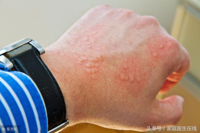 夏天汗流过的皮肤发痒,还有这些表现,你可能患上汗疱疹了_健康症状网