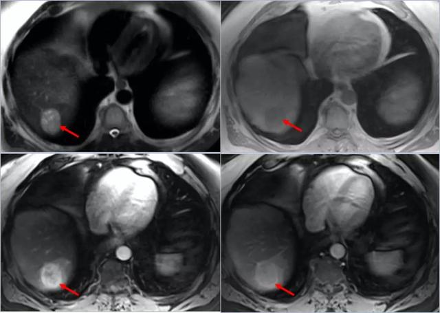 肝细胞肝癌磁共振表现有哪些