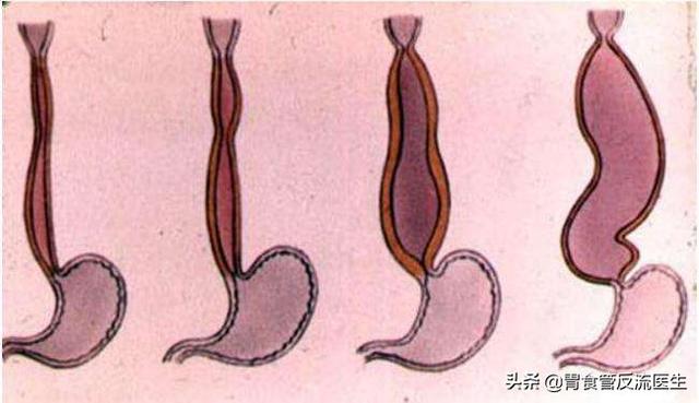 贲门松弛食管裂孔疝怎么才能知道这些情况的出现是否严重