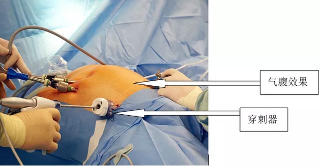 术中出现了皮下气肿该如何处理