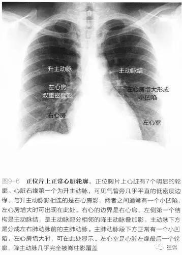 心脏轮廓■在正位胸片上,正常心影由-系列的凸出和凹陷组成(图9-6)