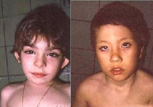 "歌舞伎面谱综合征",产检查不出的罕见病