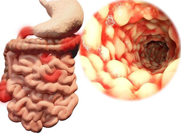 身體一旦出現這5種異常,十有八九是腸癌來了,需及時檢查_健康症狀網