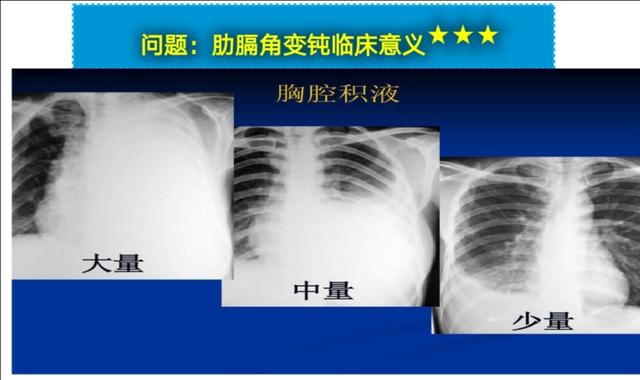 如何通过胸片判断胸腔积液量
