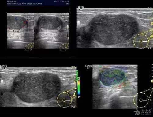 乳腺纖維瘤的超聲診斷