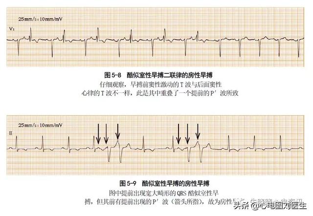 房性早搏伴室内差异性传导与室性早搏的鉴别