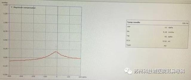 教您读懂声导抗检查报告