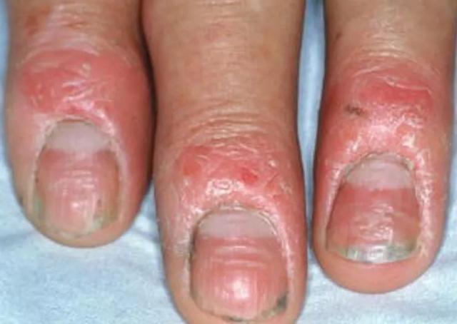 10种可能误诊为甲真菌病的指甲病变
