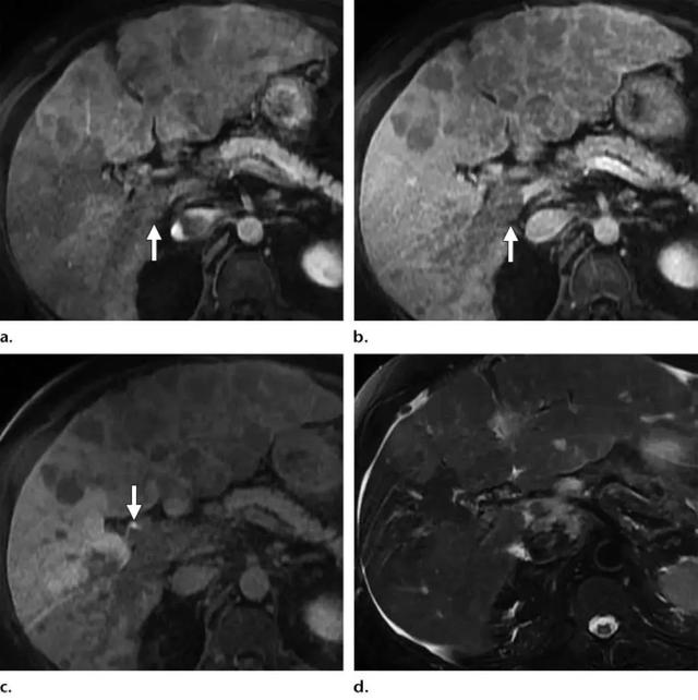 肝细胞肝癌磁共振表现有哪些