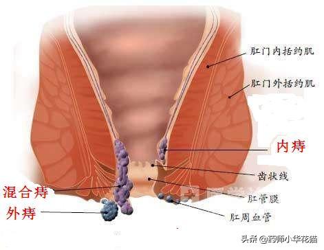 21种治疗痔疮的常用药品轻松治疮