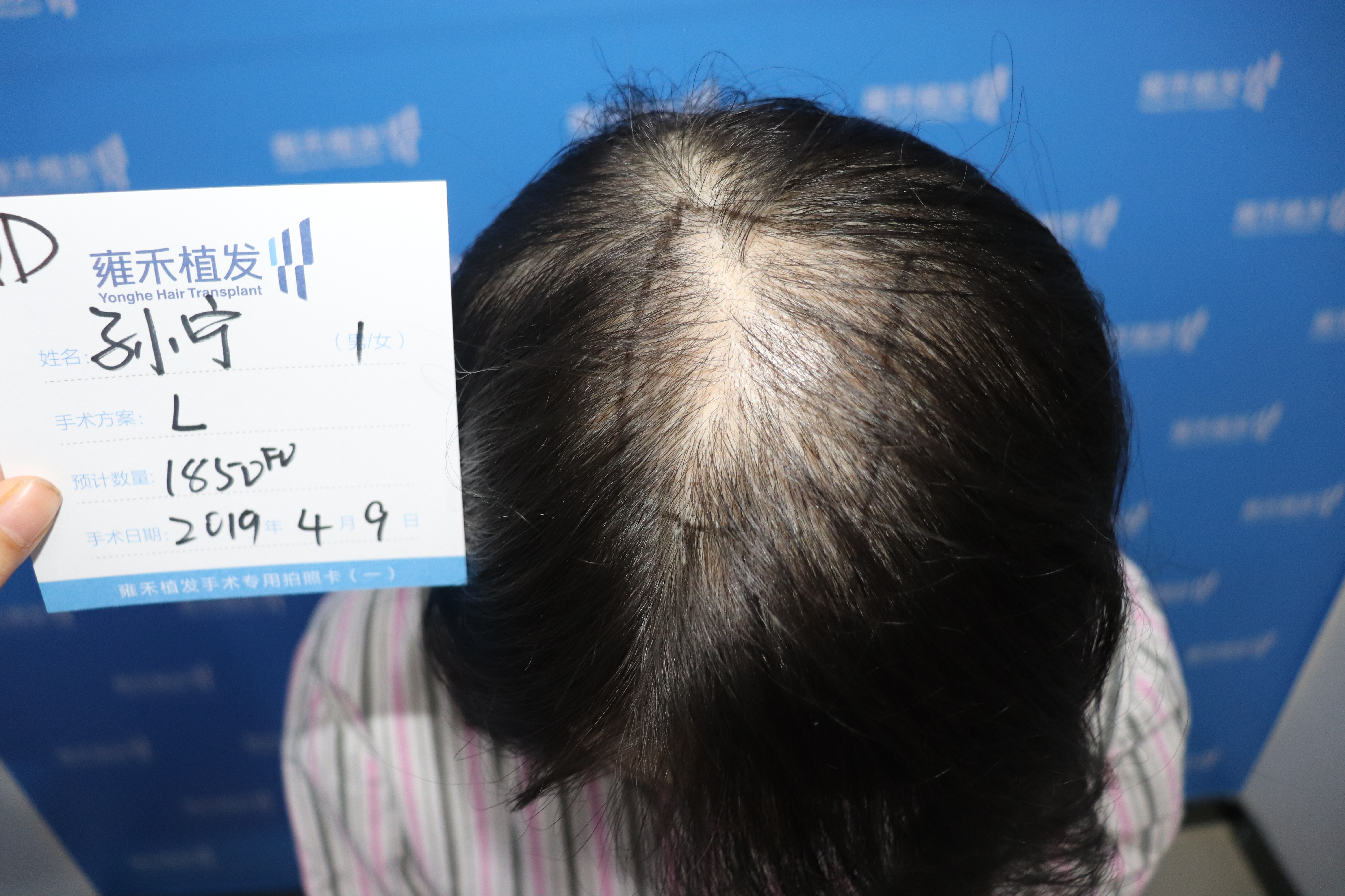 头顶稀疏越掉越多多久才能恢复浓密四位发友改善一年成功变身