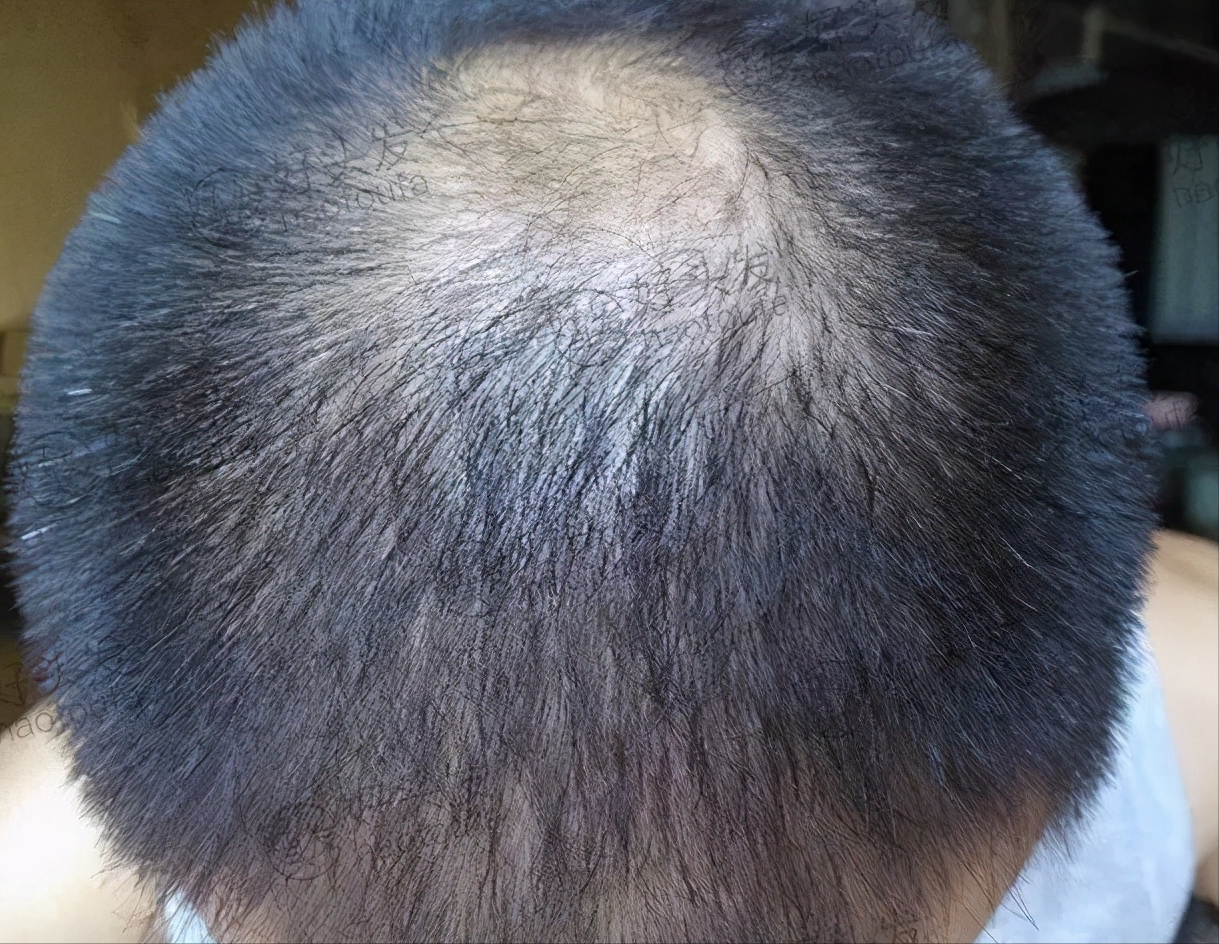 中年男人5级遗传性脱发一年之后大变身
