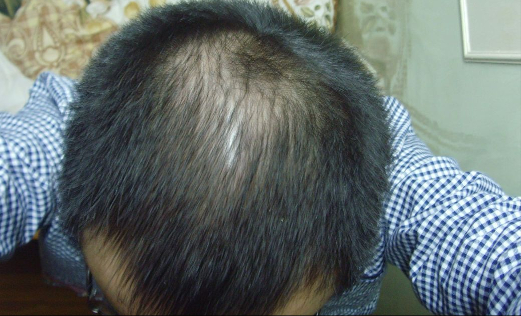 8年遗传性脱发,治疗一年这效果能打几分?(附带五位发友案例)